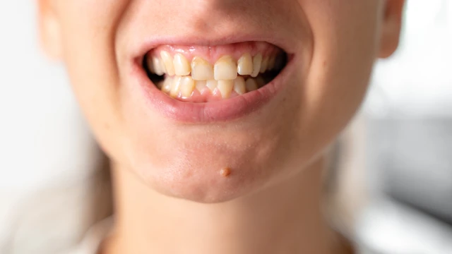 Lệch khớp cắn là gì? Khi nào cần can thiệp điều trị lệch khớp cắn?