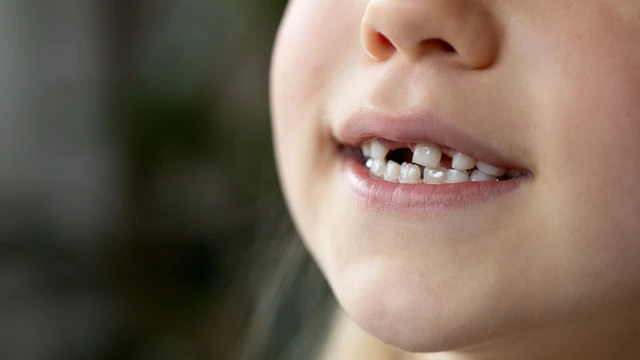 Lịch thay răng sữa theo từng độ tuổi: Dấu hiệu và cách chăm sóc đúng