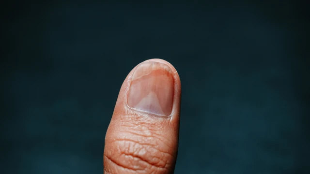 Loạn dưỡng móng: Dấu hiệu nhận biết, nguyên nhân và cách chăm sóc đúng cách