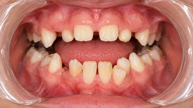 Loạn sản xương đòn sọ là gì? Nguyên nhân, dấu hiệu, chẩn đoán và điều trị
