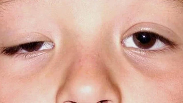 Mắt to mắt nhỏ: Nguyên nhân và các phương pháp khắc phục hiệu quả