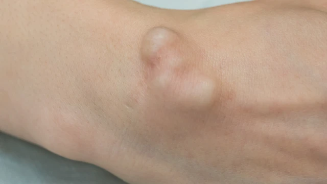 Mẹo chữa u bao hoạt dịch khớp cổ tay tại nhà: Có hiệu quả không?