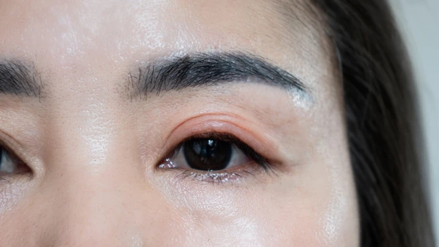 Mí mắt bị sưng và ngứa​ là do đâu? Cách khắc phục hiệu quả