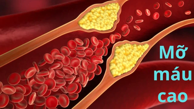 Mỡ máu cao là gì? Nguyên nhân và cách điều trị hiệu quả