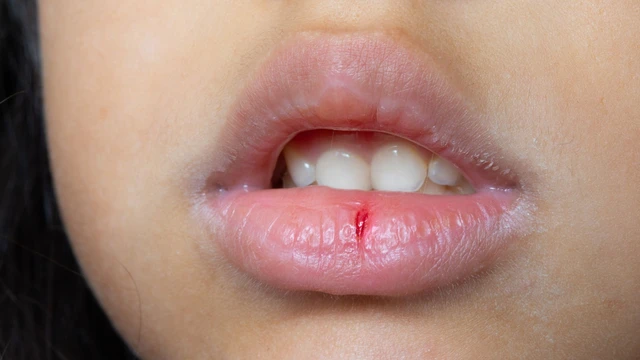 Môi nhợt nhạt là thiếu chất gì? Nguyên nhân thường gặp và cách cải thiện
