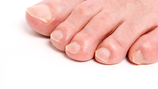Móng chân có sọc đen là gì? Cảnh báo sức khỏe không nên bỏ qua