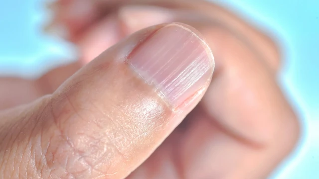 Móng tay bị sọc dọc là thiếu chất gì? Hướng dẫn cách chăm sóc