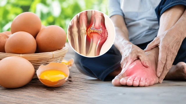 Mùa hè người axit uric cao ăn trứng thế nào để không làm tăng gout?