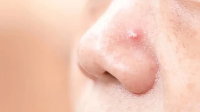 Mụn bọc ở mũi là do đâu? Dấu hiệu và cách phòng ngừa hiệu quả