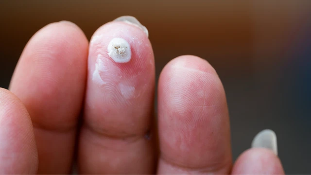 Mụn cóc chảy máu có gây nguy hiểm? Cách điều trị mụn cóc hạn chế chảy máu