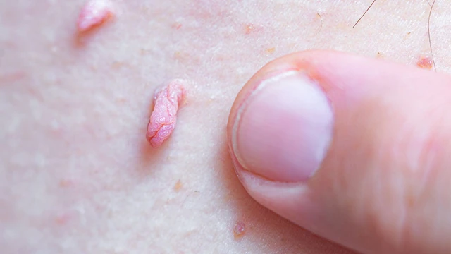 Mụn cóc hậu môn là gì? Biện pháp phòng ngừa bệnh mụn cóc hậu môn