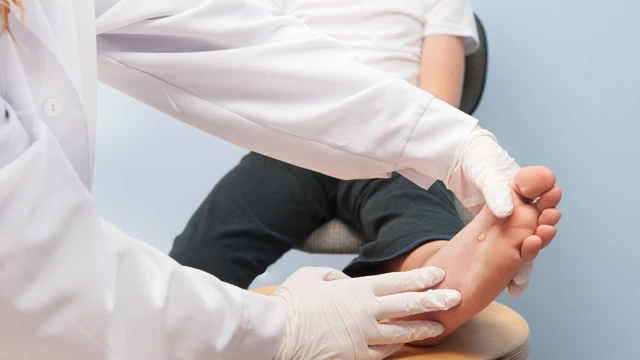 Mụn cóc ở trẻ em có khả năng lây lan không? Cách điều trị hiệu quả