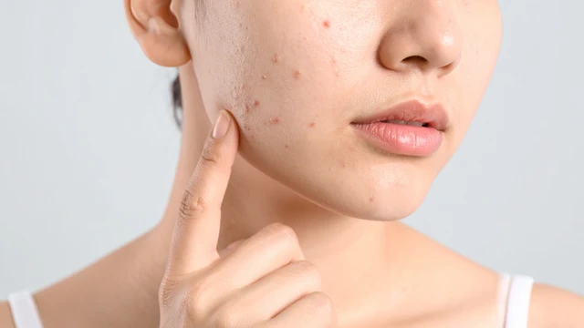 Mụn nấm men là gì? Dấu hiệu nhận biết và cách điều trị hiệu quả