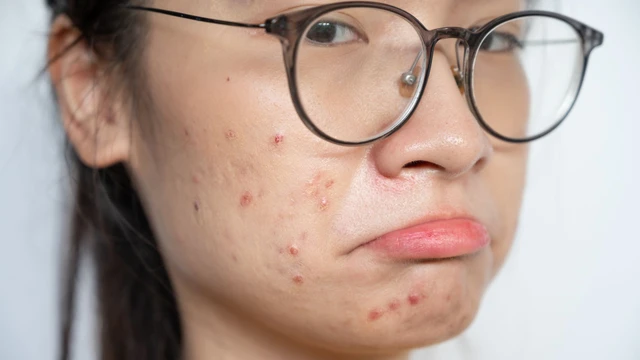Mụn nhọt bị nhiễm trùng: Dấu hiệu nhận biết và biến chứng