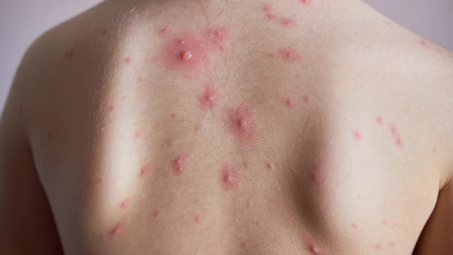 Mụn nước tay chân miệng và thủy đậu: Cách phân biệt rõ ràng qua dấu hiệu điển hình