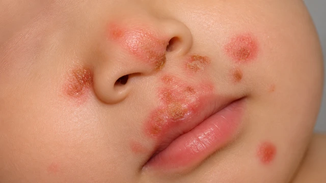 Mụn rộp sinh dục ở trẻ em: Dấu hiệu cần đi khám