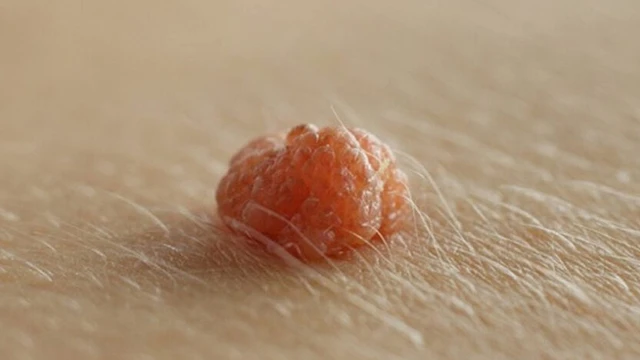 Mụn thịt dư ở vùng kín là bị gì? Dấu hiệu nhận biết và cách xử lý
