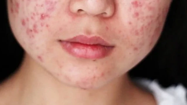Mụn tuổi dậy thì có tự hết không? Vì sao mụn tuổi dậy thì xuất hiện và kéo dài?