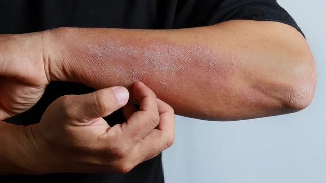 Ngứa râm ran khắp người không nổi mẩn: Nguyên nhân và cách khắc phục
