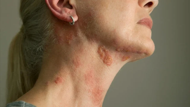 Bị giời leo ở cổ do nguyên nhân gì và cách xử lý hiệu quả