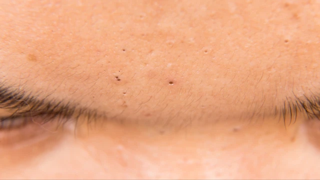 Mụn đầu đen ở trán do đâu? Cách điều trị hiệu quả
