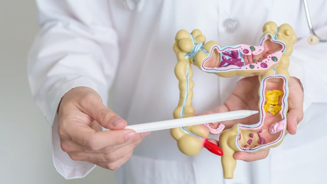 Nhận biết dấu hiệu polyp đại tràng​ giai đoạn sớm