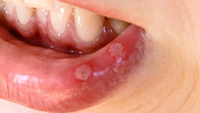 Nhận biết hình ảnh nhiệt miệng qua từng giai đoạn và thời điểm cần đi khám