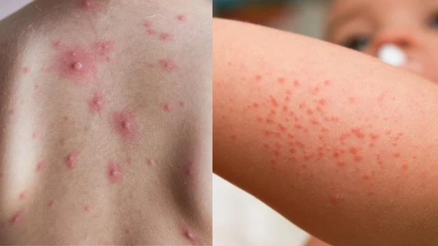 Nhận biết nốt thủy đậu với xuất huyết dưới da trong sốt xuất huyết