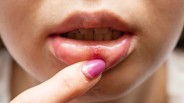 Nổi bóng nước trong miệng có nguy hiểm không? Nguyên nhân và cách xử lý hiệu quả