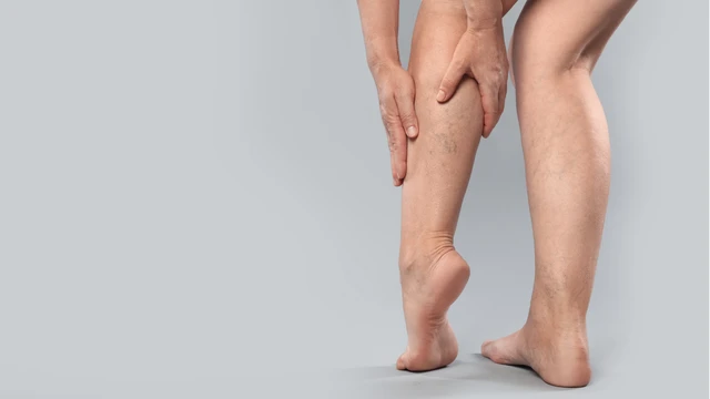 Nổi gân tím ở chân: Nguyên nhân, dấu hiệu và cách xử lý