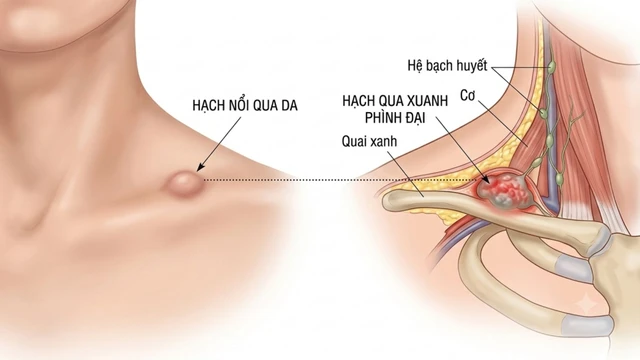 Nổi hạch ở xương quai xanh là dấu hiệu gì? Nguyên nhân và khi nào cần đi khám