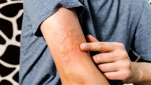 Nổi mề đay là gì? Nguyên nhân, triệu chứng, chẩn đoán và cách điều trị