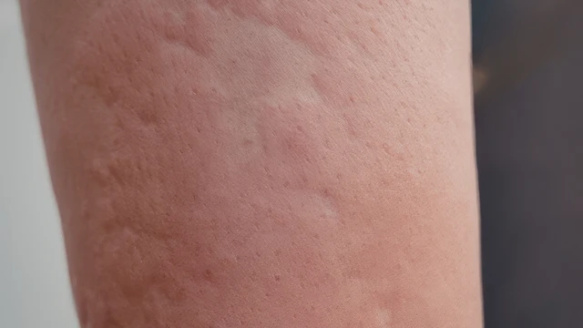 Nổi mề đay cấp tính: Nguyên nhân, mức độ nguy hiểm và cách xử trí