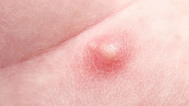 Nổi mụn bọc ở vùng kín nguyên nhân do đâu? Cách xử lý