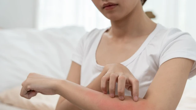 Nguyên nhân nổi mụn nước ngứa là gì? Những bệnh gây nổi mụn nước ngứa thường gặp