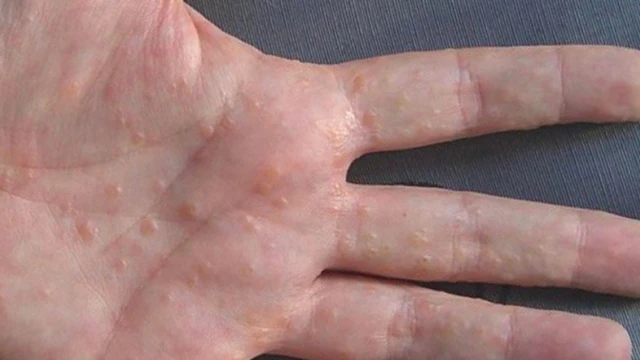 Nổi mụn nước ở lòng bàn tay do đâu? Cách phòng ngừa hiệu quả