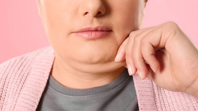Nọng cằm hình thành do đâu? Cách cải thiện và hạn chế nọng cằm