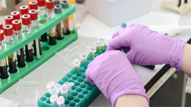 Nồng độ virus viêm gan B bao nhiêu là cao? Các biện pháp phòng bệnh hiệu quả