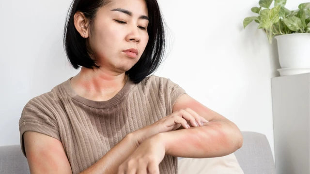 Nóng gan nổi mề đay: Nguyên nhân và cách xử lí
