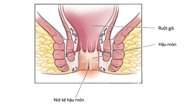 Nứt kẽ hậu môn sau sinh: Dấu hiệu và cách cải thiện