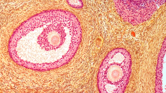 PCOS với u nang buồng trứng: Điểm khác biệt quan trọng ảnh hưởng sinh sản