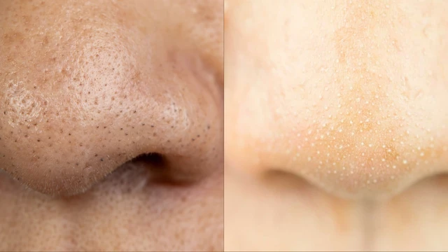 Phân biệt mụn đầu đen và sợi bã nhờn như thế nào? Cách xử lý hiệu quả