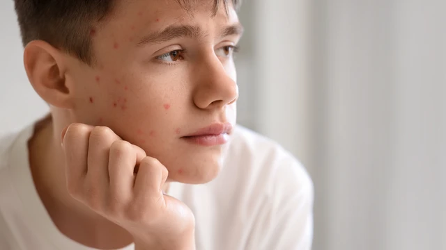  Mụn đinh râu và mụn bọc mủ: Phân biệt nguyên nhân gây bệnh, cách nhận biết