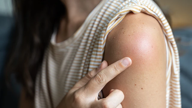 Phản ứng sau tiêm phòng dại: Những điều cần biết để bảo vệ sức khỏe