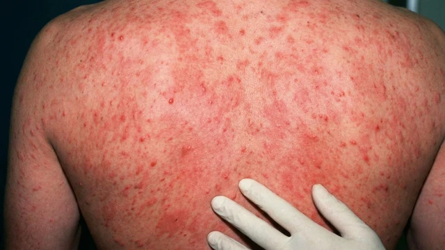 Phát ban HIV có ngứa không? Nhận biết đúng để không hoang mang
