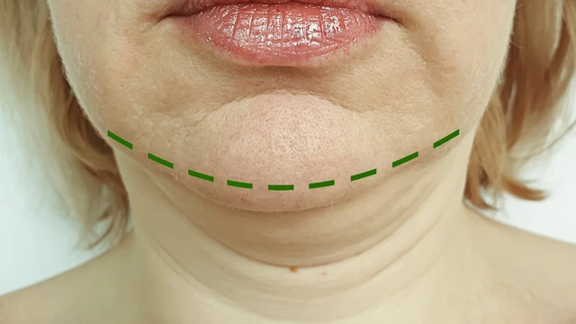 Phẫu thuật trượt cằm là gì? Những điều cần biết trước khi thực hiện