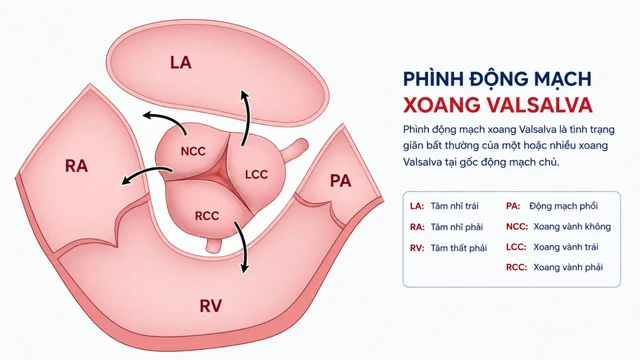Phình động mạch xoang Valsalva: Dấu hiệu, nguyên nhân và điều trị
