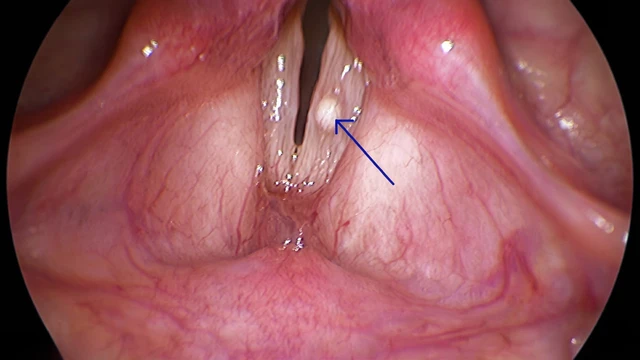 Polyp thanh quản: Nguyên nhân, dấu hiệu và cách điều trị thường gặp
