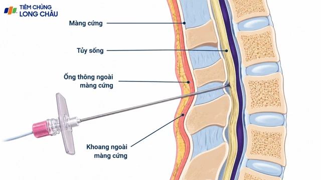 Quá trình gây tê ngoài màng cứng khi chuyển dạ diễn ra thế nào?