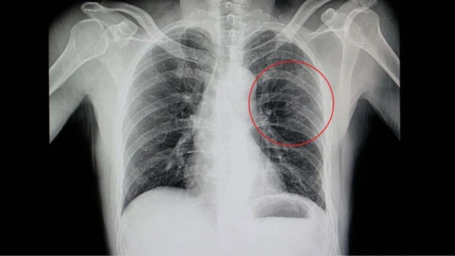 Rạn xương sườn bao lâu thì khỏi? Lưu ý trong điều trị và chăm sóc giúp hồi phục đúng, an toàn